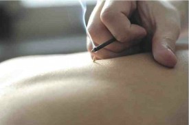 はり・きゅう治療