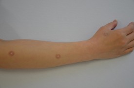 円皮鍼（パイオネックス）